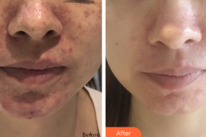 廣州新時代整形美容醫(yī)院熊英整形價格表附果酸煥膚案例展示