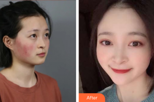 廣州遠東美容醫(yī)院馮潔整形價格表附微針修復敏感肌案例展示