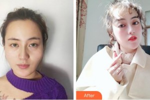 上海明慨醫(yī)療美容門診部王胡飛整形價(jià)格表附顴骨顴弓整形術(shù)案例展示