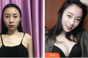 上海明慨醫(yī)療美容門診部慎孔宇整形價(jià)格表附假體隆胸案例展示