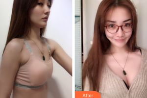 廣州星團醫(yī)學美容門診部祖秉毅整形價格表附濃縮豐胸案例展示