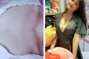 貴陽長(zhǎng)江醫(yī)院整形美容中心韓盛斌整形價(jià)格表附假體隆胸案例展示