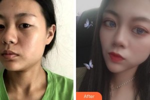 醫(yī)療美容門診部何祥龍整形價(jià)格表附洛麗塔美眼案例展示