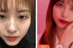 上海美侖醫(yī)療美容門診部胡曉龍整形價(jià)格表附超激光美膚嫩膚多方面部案例展示