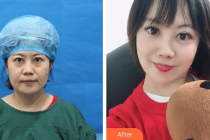 上海百達(dá)麗醫(yī)療美容醫(yī)院韓嘉毅整形價(jià)格表附不開刀祛眼袋+自體脂肪填充淚案例展示