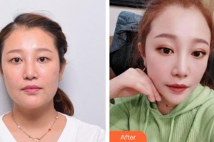 上海百達(dá)麗醫(yī)療美容醫(yī)院邵玉芳整形價(jià)格表附埋線雙眼皮+去脂案例展示