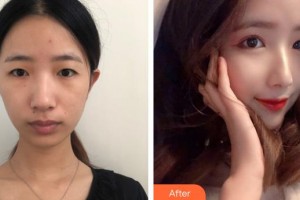 上海華美醫(yī)療美容醫(yī)院張柱允整形價(jià)格表附埋線雙眼皮案例展示