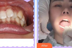 上海伊萊美醫(yī)療美容醫(yī)院李真旼整形價(jià)格表附牙綜合案例展示