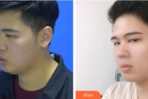 上海美立方整形醫(yī)院鄭裕賢整形價(jià)格表附面部輪廓案例展示