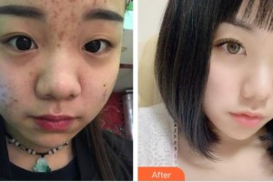 上海天大醫(yī)療美容醫(yī)院張杏整形價(jià)格表附點(diǎn)陣激光祛痘印痘坑案例展示