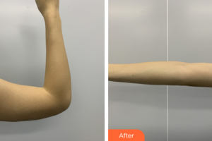 廣州美涵醫(yī)療整形美容醫(yī)院李青葉主診醫(yī)師整形價格表附手臂吸脂案例展示