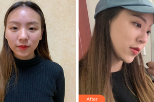 廣州星團醫(yī)學美容門診部田夫整形價格表附自體肋軟骨隆鼻案例展示