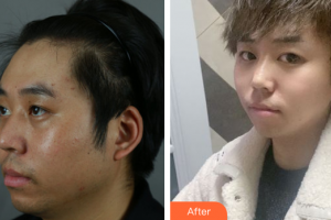 廣州星團醫(yī)學美容門診部劉歡整形價格表附下頜角+皮質骨+夾脂墊案例展示