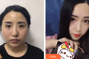 廣州星團醫(yī)學美容門診部張少博整形價格表附面部吸脂案例展示