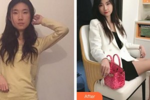 桂林華美醫(yī)療美容門診部趙麗紅整形價(jià)格表附玻尿酸導(dǎo)入精華案例展示