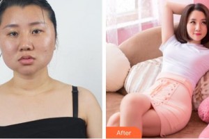 宜昌華美美星整形美容醫(yī)院屈平安整形價(jià)格表附濃縮脂肪豐胸案例展示