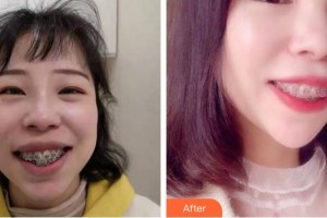 宜昌第二人民醫(yī)院醫(yī)學(xué)美容科張渝寧整形價(jià)格表附口腔隱形矯正案例展示