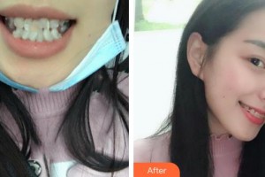 宜昌第二人民醫(yī)院醫(yī)學(xué)美容科閔小勇整形價(jià)格表附瓷貼面案例展示