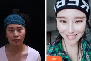 合肥劉大夫美容整形醫(yī)院劉向陽(yáng)整形價(jià)格表附鼻部綜合案例展示