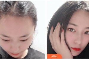 上海韓鏡醫(yī)療美容醫(yī)院魏敬想整形價(jià)格表附發(fā)際線種植案例展示