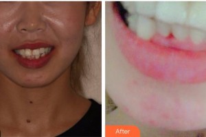 上海紐菲思醫(yī)療美容門診部趙炳澳整形價(jià)格表附牙齒隱形矯正案例展示