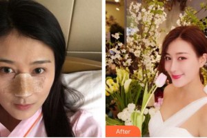 上海馥蘭朵醫(yī)療美容門診部劉小川整形價(jià)格表附鼻部手術(shù)案例展示