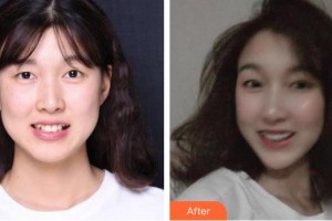 上海科瓦口腔門診部季愛萍整形價格表附隱形托槽矯正案例展示