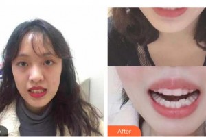 上海維佳康口腔醫(yī)院吳鳳霞整形價格表附隱形牙齒矯正案例展示