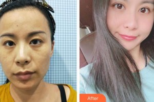 上海明潭眼科門診部王素羽整形價格表附眼部手術案例展示