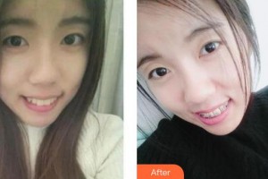 上海雅悅口腔門診部趙鄭整形價格表附金屬托槽矯正案例展示