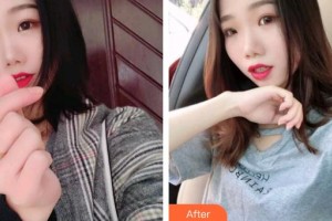 上海迪寇醫(yī)療美容門診部任亮整形價格表附多方面部埋線提升案例展示