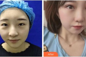 上海希瑪瑞視眼科醫(yī)院張士勝整形價(jià)格表附全切雙眼皮+去皮去脂案例展示