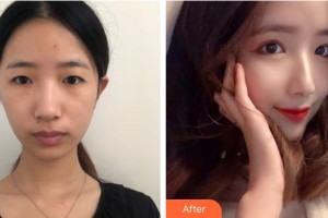 上海?，斎鹨曆劭漆t(yī)院郭慶整形價(jià)格表附眼部整形案例展示