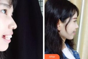 上海拜博昌仁口腔門診部尹琪琪整形價(jià)格表附牙齒矯正案例展示