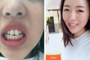 上海維樂口腔門診部沈華整形價(jià)格表附門牙擁擠、齙牙案例展示
