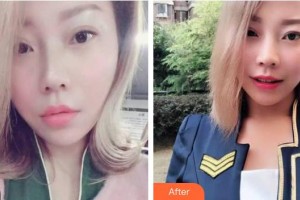 上海摩爾口腔門診部陳建榮整形價(jià)格表附牙齒隱形矯正案例展示