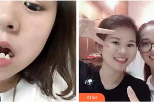 上海匯尚口腔門診部曹亞順整形價(jià)格表附牙齒矯正案例展示