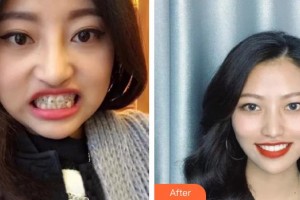 上海匯尚口腔門診部王刃整形價(jià)格表附牙齒矯正案例展示