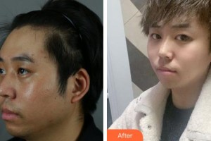 上海紐菲思醫(yī)療美容門診部曾垂紳整形價(jià)格表附下頜角整形案例展示