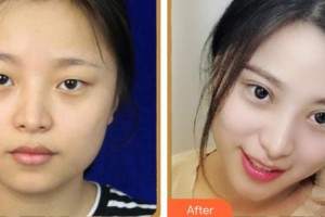 上海容妍醫(yī)療美容門診部柴云整形價(jià)格表附鼻部手術(shù)案例展示