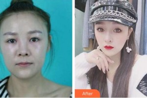 上海容妍醫(yī)療美容門診部袁鹿整形價(jià)格表附面包臉到鴨蛋臉變形記案例展示