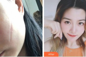 上海明珠醫(yī)院整形美容中心崔春雷整形價(jià)格表附手術(shù)祛疤案例展示