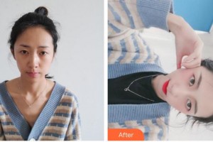 上海萊森醫(yī)療美容門診部王彥坤整形價(jià)格表附發(fā)際線種植案例展示