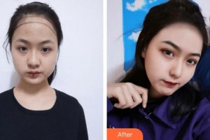 上海萊森醫(yī)療美容門診部李少雄整形價(jià)格表附美女發(fā)際線種植案例展示