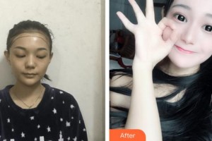 上海星璨醫(yī)療美容醫(yī)院張勍峰整形價(jià)格表附發(fā)際線種植案例展示