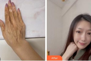 上海瑞金醫(yī)院舟山分院燒傷整形美容科郇京寧整形價(jià)格表附傷燙傷疤痕案例展示