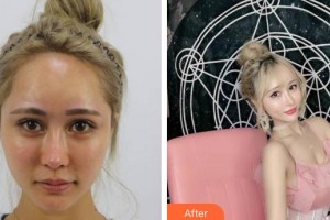 上海南山醫(yī)院美容外科王虎軍整形價(jià)格表附酒窩案例展示