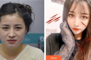 上海南山醫(yī)院美容外科韓立志整形價(jià)格表附面部光纖案例展示