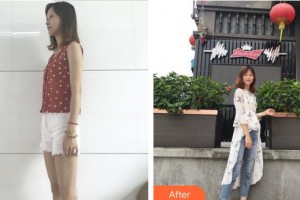 上海麗園醫(yī)療美容門診部潘偉整形價(jià)格表附燙傷疤痕案例展示