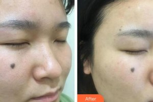 上海麗質(zhì)整形美容醫(yī)院胡彩艷整形價(jià)格表附毛孔粗大案例展示